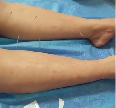 喜迎两会重点推荐  国医名师---潘江涛  中医针灸理疗领域的璀璨明星