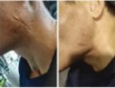 回归本源，让疤痕收回本该易防易治的本来形象！  去除疤痕——几千年做错了这一件事  排毒养疤——让疤痕还回了本容易康复的事情