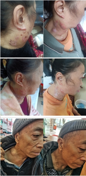 痛风结石老鼠疮乳腺增生无效退款广西百色杨忠雅医师