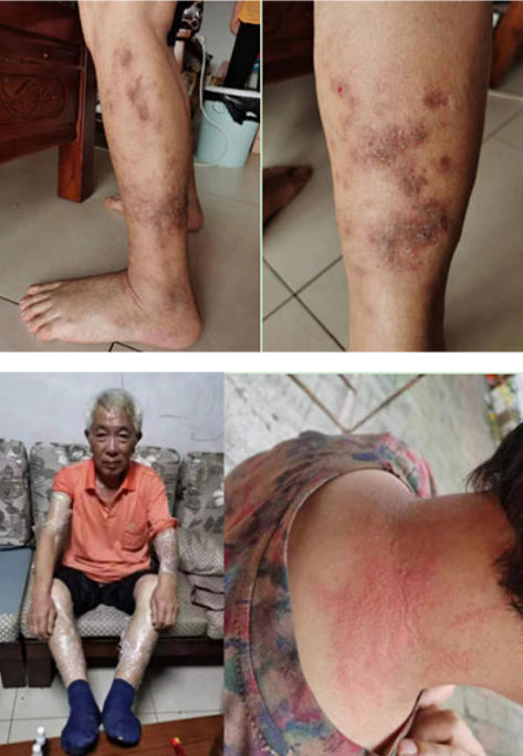 马年新春大拜年：承千年中医韵，暖万家健康情——访著名股骨头病专家严德华